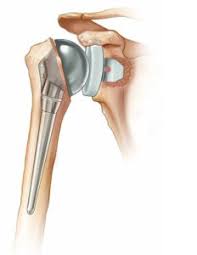 Arthroscopy $4000